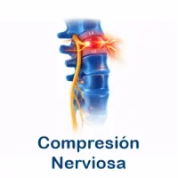 compresion-nerviosa