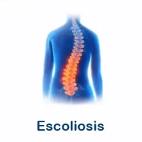 escoliosis