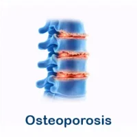 osteoporosis
