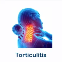 torticulitis